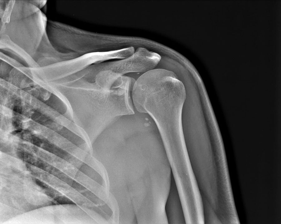 Radiografia artrozei articulației umărului de gradul 2 de severitate