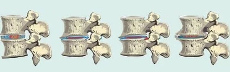 leziune a coloanei vertebrale în caz de osteocondroză toracică
