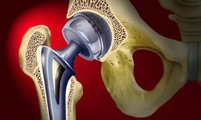 înlocuirea articulației șoldului pentru artroză