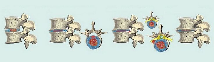 Etapele formării osteocondrozei coloanei vertebrale