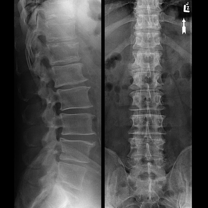 Raze X ale regiunii toracice, care arată o scădere a decalajului dintre vertebre de-a lungul coloanei vertebrale de jos în sus
