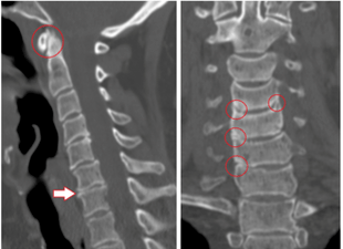 Scanarea CT arată vertebre și discuri deteriorate de înălțime eterogenă din cauza osteocondrozei toracice