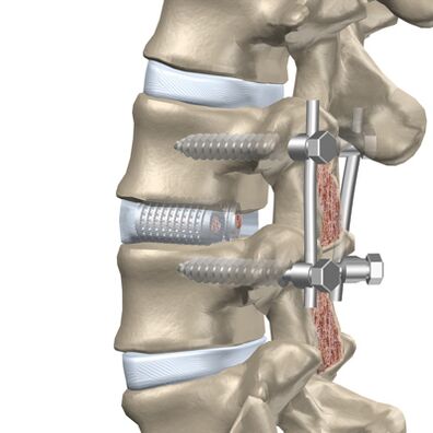 Înlocuirea unui disc distrus al coloanei vertebrale toracice cu un implant artificial