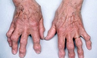 cum să distingem artrita degetelor de artroză