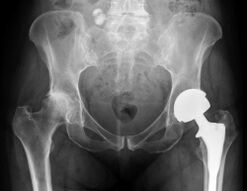 diagnosticul de artroză a articulației șoldului