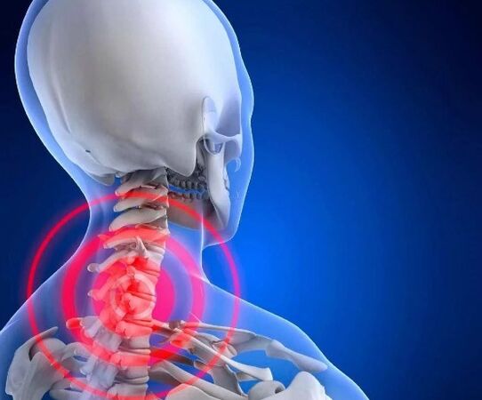Osteocondroza cervicală