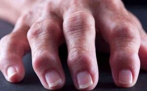 artrita reumatoidă ca cauză a durerilor articulare